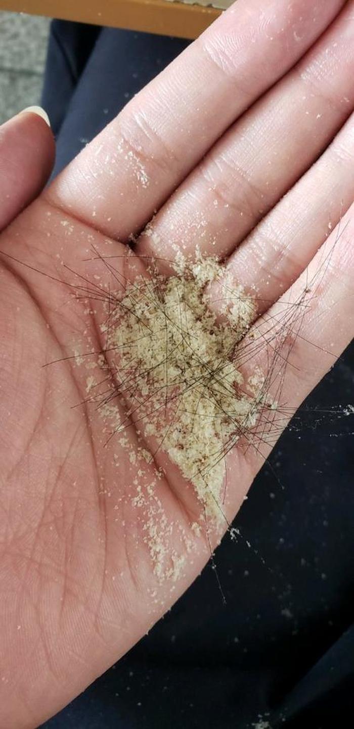 生活中的小常识头屑 用什么可以去头皮屑？