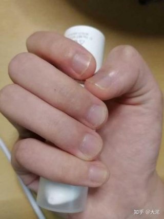 日常养生知识大全看指甲，咬指甲后甲床怎么恢复