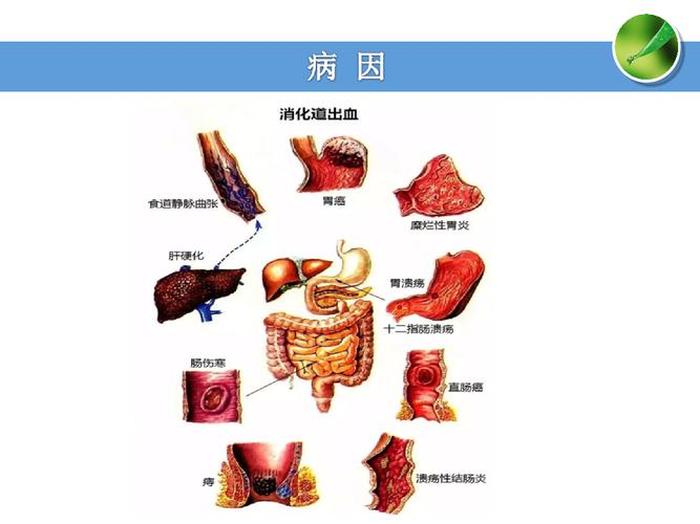 消化内科科普知识视频 消化道出血宣教动画视频