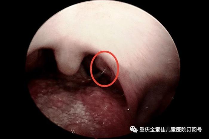 生活小窍门小常识喉咙有鱼刺；鱼刺会一直卡在喉咙吗