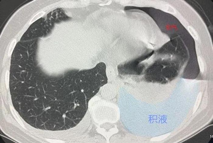 肝血吸虫病ct表现 肝血吸虫病ct影像学表现