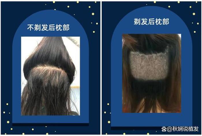 植发技术怎么学（植发怎么入行）