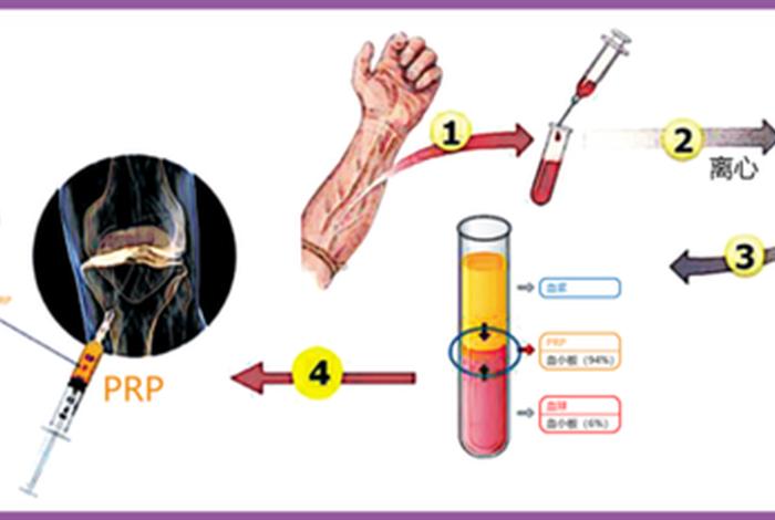 富血小板血浆治疗技术prp 富血小板血浆治疗技术(PRP)
