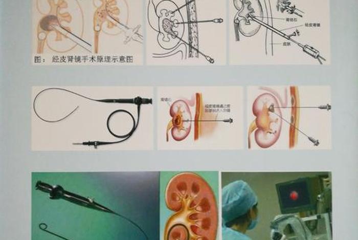 输尿管镜学习方法 输尿管镜介绍