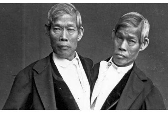 连体人结婚怎么过夫妻生活、连体人结婚怎么办 连体人结婚怎么过夫妻生活、连体人结婚怎么办