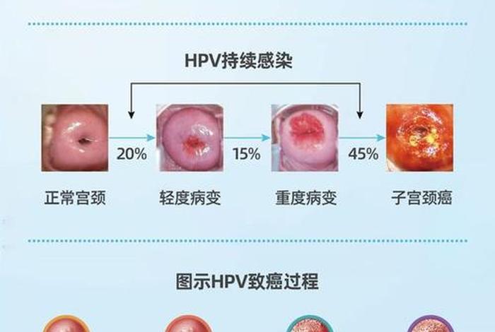 几岁性生活容易宫颈癌、几岁性生活会得宫颈癌 几岁性生活容易宫颈癌、几岁性生活会得宫颈癌