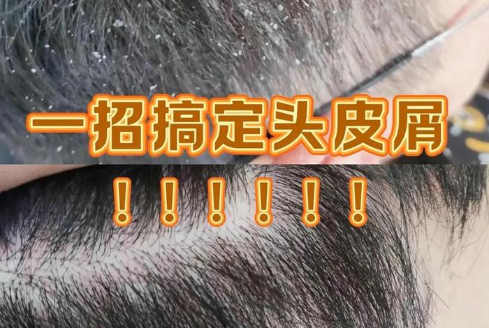 根除头屑妙招窍门 去头屑的小妙方