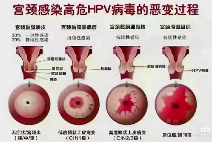 几岁性生活容易宫颈癌、几岁性生活会得宫颈癌 几岁性生活容易宫颈癌、几岁性生活会得宫颈癌