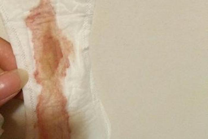 生理活动后白带增多 生理活动后少量出血