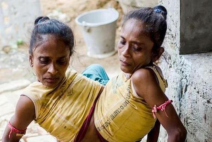 连体人结婚怎么过夫妻生活、连体人结婚怎么办 连体人结婚怎么过夫妻生活、连体人结婚怎么办