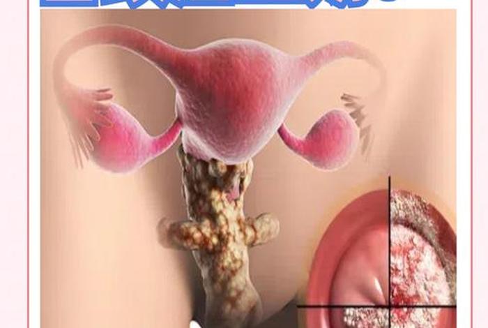 几岁性生活会导致宫颈癌 性生活几年会形成宫颈癌