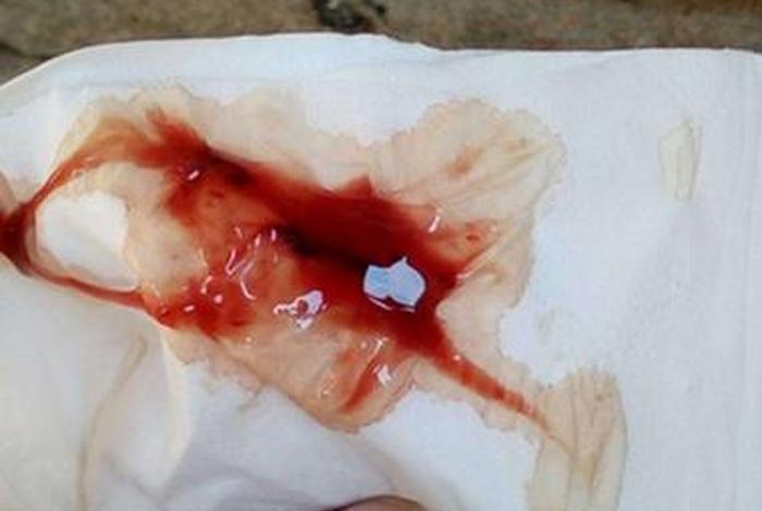 生理活动后白带增多 生理活动后少量出血