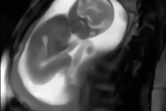 怀孕夫妻生活会造成胎儿畸形吗 - 怀孕夫妻性生活会导致流产吗 怀孕夫妻生活会造成胎儿畸形吗 - 怀孕夫妻性生活会导致流产吗