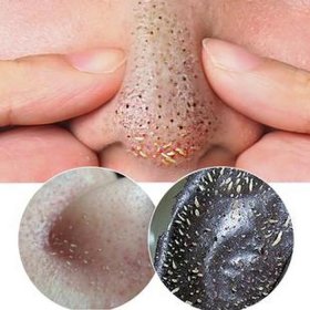 生活小窍门妙招除螨虫视频、鼻子上的黑头是螨虫吗