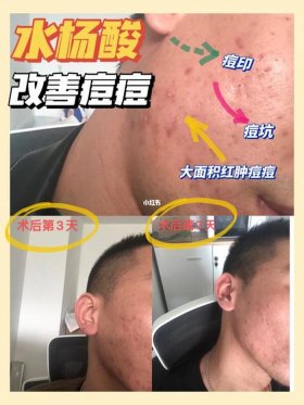 实用冷知识祛痘；科学祛痘方法