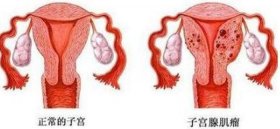女性子宫健康知识百科、女人没有子宫有什么影响