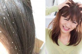 生活中的小常识头屑 用什么可以去头皮屑？