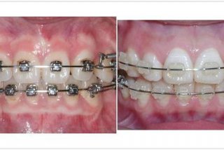 出国学习正畸 出国整牙
