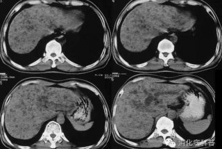 肝血吸虫病ct表现 肝血吸虫病ct影像学表现