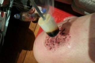 艾灸血小板低有效果吗 艾灸血小板低有效果吗女性