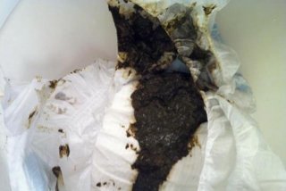 非血性黑便（黑便不是消化道出血）