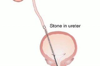 输尿管镜学习方法 输尿管镜介绍