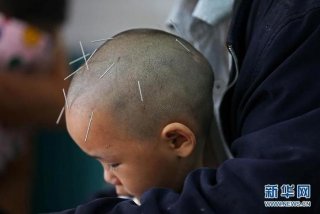 儿童学习障碍中医治疗；中医治疗儿童智力障碍