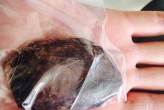 麝香血小板；麝香治血栓效果怎么样