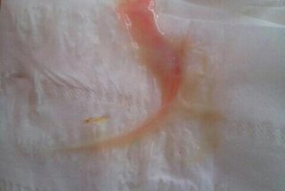 白带带血丝是怎么回事呢，女性分泌物里有血丝是怎么回事