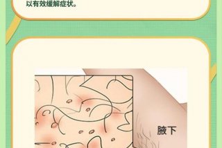 白带像豆渣一样怎么回事，下面瘙痒还有豆腐渣一样的分泌物