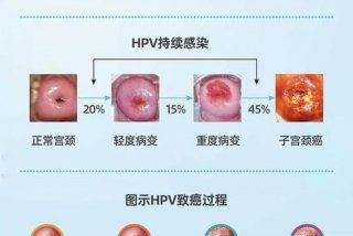 几岁性生活容易宫颈癌、几岁性生活会得宫颈癌