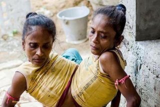 连体人结婚怎么过夫妻生活、连体人结婚怎么办