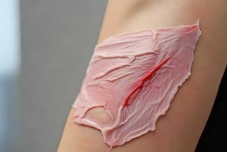 割完皮3一5天的图片，割完皮3一5天的图片水肿几天能好