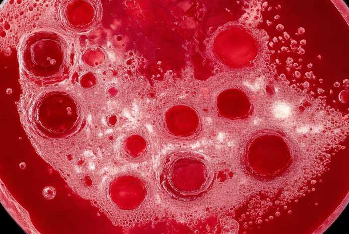 粒系增生活跃,红系增生明显活跃,铁染色-提示缺铁（增生活跃,粒系增生减低,红系增生明显活跃）