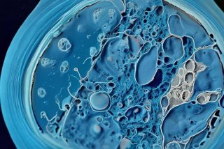 ()鳞状上皮状瘤样增生部分细胞增生活跃 鳞状上皮状瘤样增生伴hpv感染