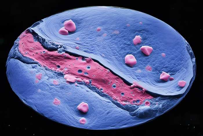 ()鳞状上皮状瘤样增生部分细胞增生活跃 鳞状上皮状瘤样增生伴hpv感染