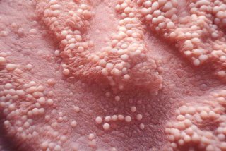 局灶痣细胞增生活跃（局灶痣细胞增生活跃伴轻度异型）