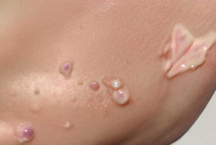 痘痘形成相关文献、关于痘痘的文献