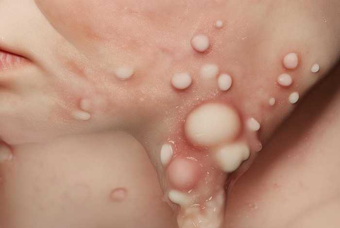 痘痘形成相关文献、关于痘痘的文献