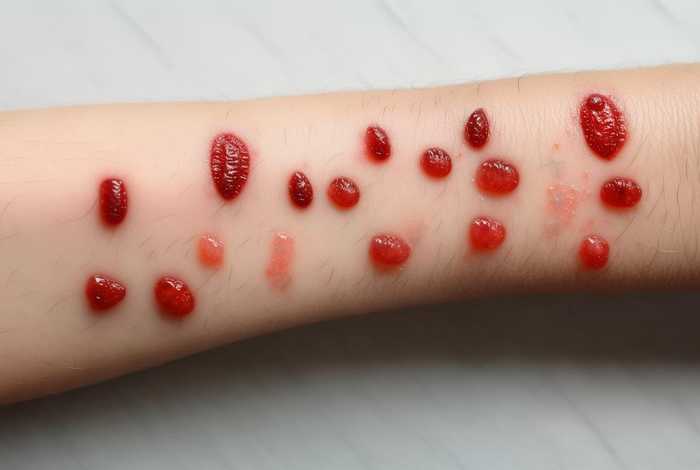 生活中常见的虫子叮咬图片;生活中常见的虫子叮咬图片大全 生活中常见的虫子叮咬图片;生活中常见的虫子叮咬图片大全