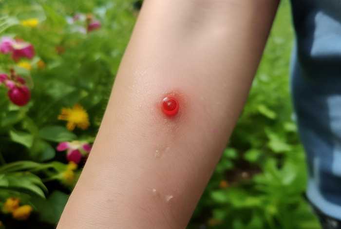 生活中常见的虫子咬人 生活中常见的虫子咬人的原因