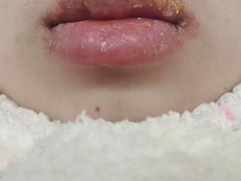 唇周感觉异常;唇周有点痛 唇周感觉异常;唇周有点痛