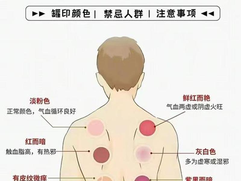 刮痧人际关系，刮痧人是什么意思