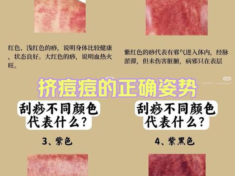 刮痧心理作用、刮痧心理作用是什么 刮痧心理作用、刮痧心理作用是什么