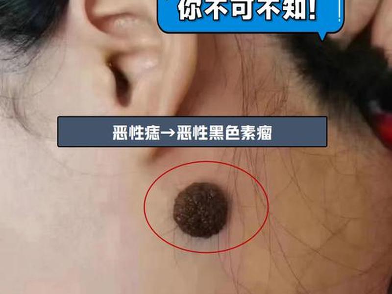 哪种痣有问题;哪种痣有问题图片 哪种痣有问题;哪种痣有问题图片