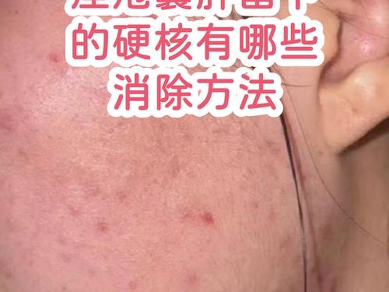 囊肿痘痘如何治疗;囊肿痘痘如何治疗图片 囊肿痘痘如何治疗;囊肿痘痘如何治疗图片