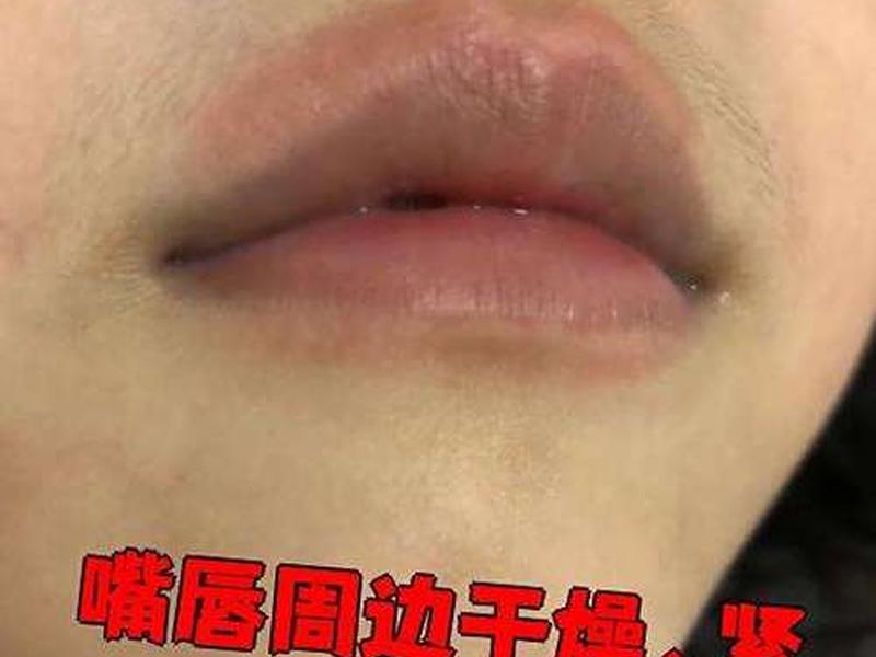 唇周干燥紧绷怎么解决 唇周干裂紧绷怎么处理 唇周干燥紧绷怎么解决 唇周干裂紧绷怎么处理