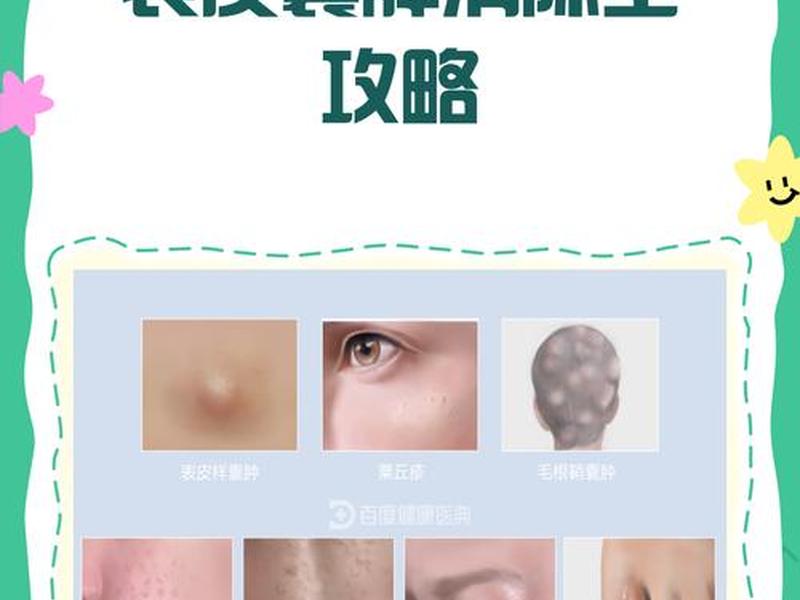 囊肿痘痘怎么消除用医美(囊肿痘痘怎么消除用医美方法) 囊肿痘痘怎么消除用医美(囊肿痘痘怎么消除用医美方法)