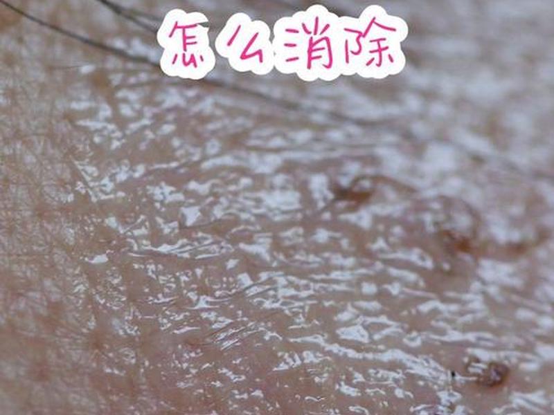 囊肿型痘痘怎么快速消下去;囊肿型痘痘怎么快速消下去图片 囊肿型痘痘怎么快速消下去;囊肿型痘痘怎么快速消下去图片