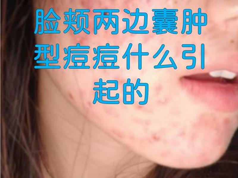 囊肿痘痘怎么处理人际关系、囊肿行痘痘怎么处理 囊肿痘痘怎么处理人际关系、囊肿行痘痘怎么处理